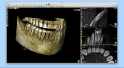 CBCT: A Critical Tool For Implantology, Orthodontics and Endodontics