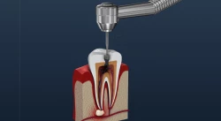 The essential tool for endodontic treatment