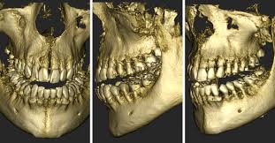 Acteon CBCT scan